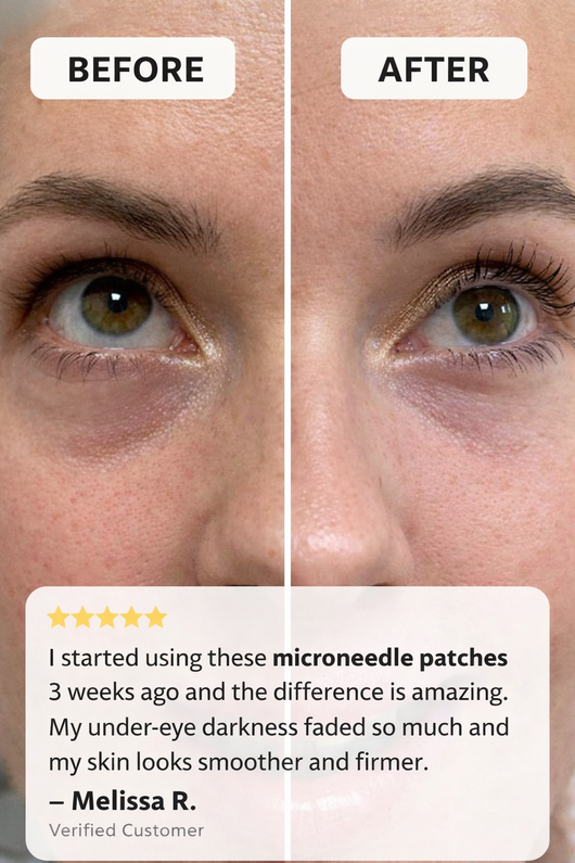 Xiori® Microneedle patches